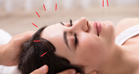 Acupuncture Treatment