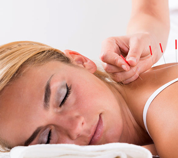 Acupuncture-Treatment